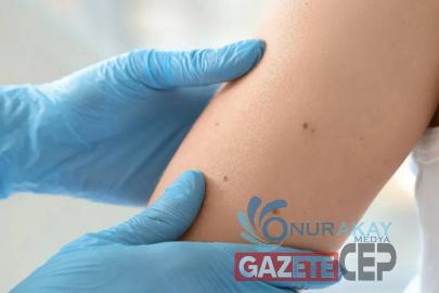 Güneşten korunmazsanız cilt kanseri riski artıyor: İşte hayat kurtaran öneriler
