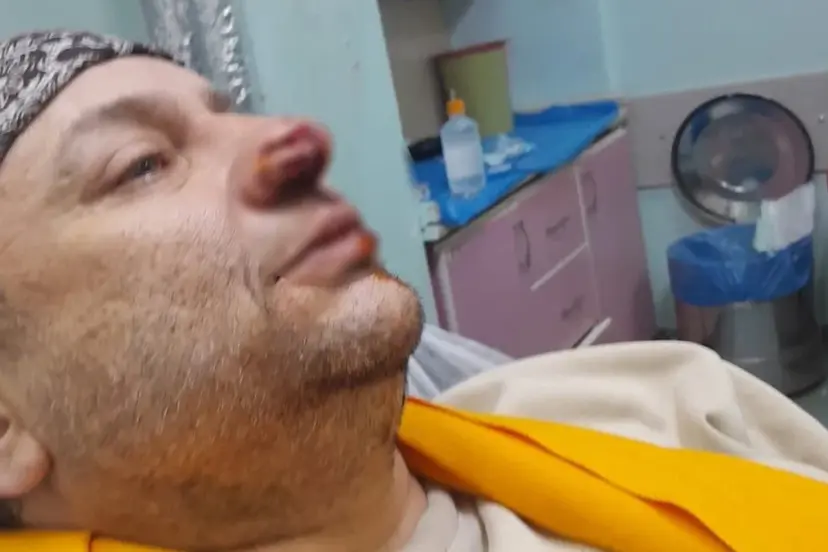 Pitbull saldırısında burnu kopan Onur Akay yoğun bakımda!